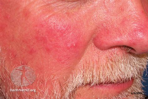 dermnet|dermnet nz rosacea.